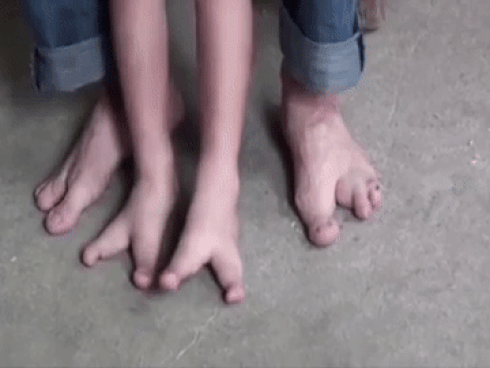 Khoảnh khắc bé trai 5 tuổi có bàn chân kỳ lạ bước đi khiến ai cũng xót xa-3
