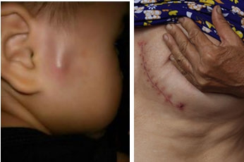 
Hình ảnh viên đạn nằm xuyên dọc dưới da bé mầm non (trái) và vết mổ trên ngực bà Lý để gắp đạn ra (phải).
