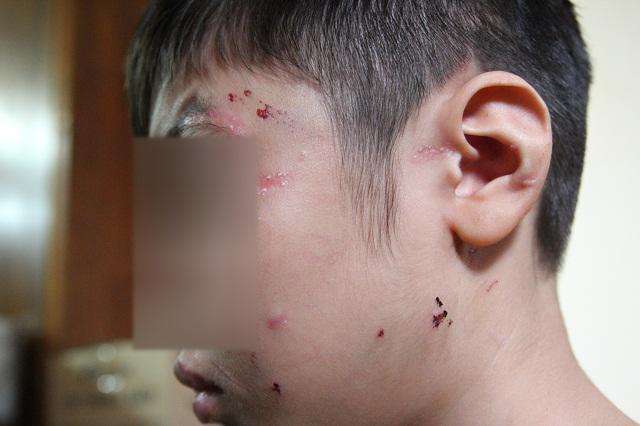 Những vết thương trên cơ thể bé trai 10 tuổi bị bạo hành ai nhìn thấy cũng xót xa-1