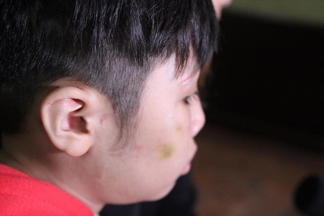 Những vết thương trên cơ thể bé trai 10 tuổi bị bạo hành ai nhìn thấy cũng xót xa-2