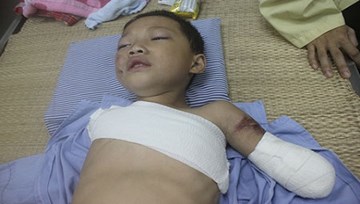 Bé trai 3 tuổi ở Sài Gòn bị gấu cắn đứt cánh tay