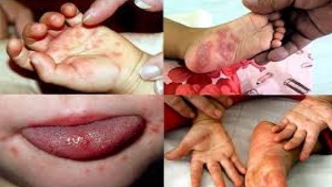 Hà Nội: Xuất hiện hàng loạt ổ dịch tay chân miệng