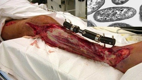 Vi khuẩn “ăn thịt người” tấn công phiến quân IS