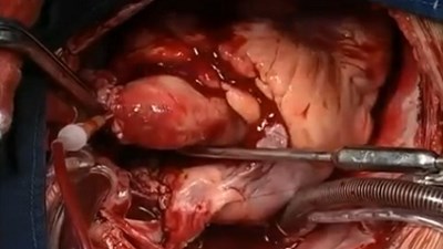 Cận cảnh quá trình cấy ghép tim cực kỳ tỉ mỉ của bác sĩ phẫu thuật