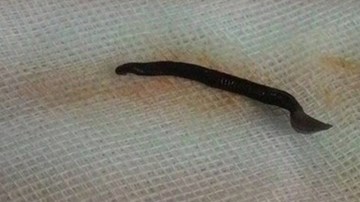 Nội soi gắp đỉa dài 4,5 cm ra khỏi mũi bệnh nhân tại TP HCM