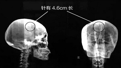 Trung Quốc : Phát hiện kim trong não 46 năm