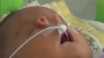 Bé sơ sinh mọc hai 