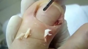 Nổi gai ốc cảnh lấy da chân mưng mủ