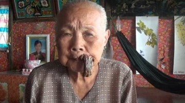 Cụ bà 87 tuổi bỗng dưng mọc sừng ngay trên miệng