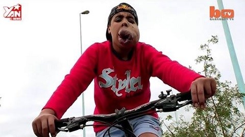 Chàng trai trẻ mang bướu trên mặt vẫn không ngừng đam mê