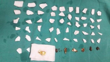 Bác sĩ mỏi tay gắp 59 mảnh chén vỡ trong bụng nam bệnh nhân