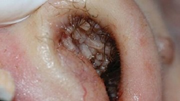 Kinh hoàng cảnh gắp giòi bò lúc nhúc trong mũi nam thanh niên