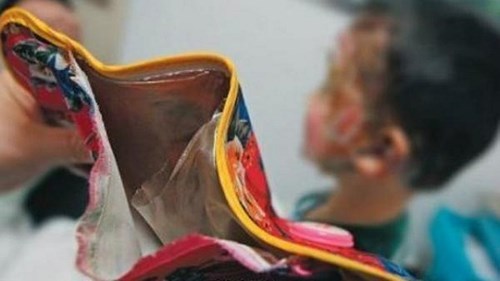 Hậu quả khôn lường từ việc dùng túi sưởi không đúng cách