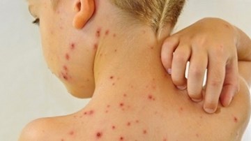 Mắc thủy đậu cần tránh ăn gì?