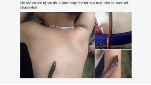 Bác sĩ nói gì về việc dùng lươn hạ sốt cho trẻ?