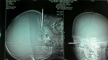 Cứu sống bé 14 tháng bị tuốc nơ vít đâm xuyên sọ