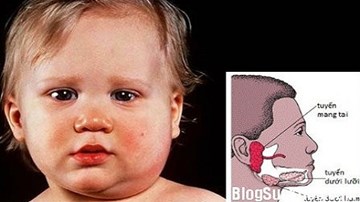 Xuất hiện ổ dịch quai bị tại Bạc Liêu
