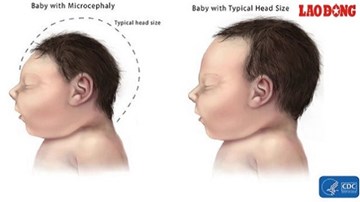 Lâm Đồng nâng cảnh báo dịch do virus Zika lên cấp độ 2