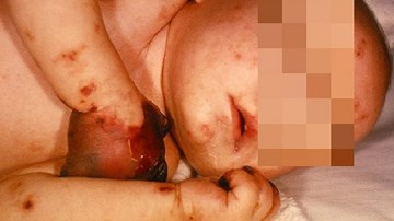 Dấu hiệu nhận biết sớm viêm não mô cầu