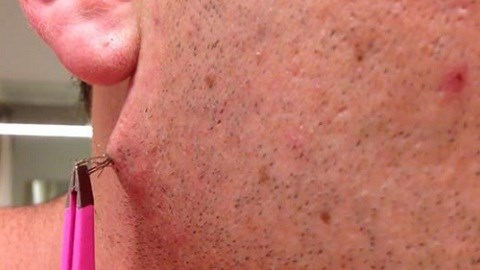Màn nhổ lông mọc ngược 