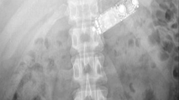 Tù nhân nuốt điện thoại dài cả gang tay để giấu quản giáo