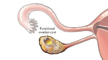 Lạc nội mạc tử cung: Nguyên nhân gây vô sinh ở phụ nữ