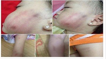 Đình chỉ trường mầm non nghi bạo hành trẻ 16 tháng tuổi