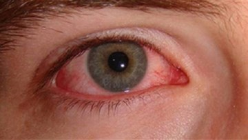 Đau mắt đỏ ở trẻ: Đâu là thủ phạm?