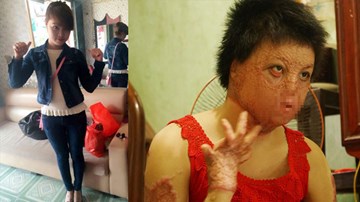 Nỗi đau người vợ trẻ bị chồng tẩm xăng thiêu sống