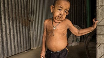 Mắc bệnh lạ, bé 4 tuổi trông như ông lão 80