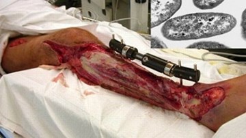 Vi khuẩn ăn thịt người tấn công cơ thể như thế nào?