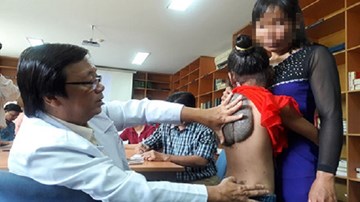 Sóc Trăng: Bé gái có khối u hình mai rùa ở lưng
