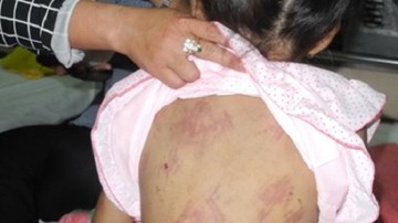 Bé gái 8 tuổi bị cha đẻ đánh đập dã man khiến dư luận dậy sóng