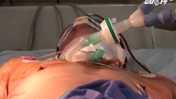 Cứu sống 1 bệnh nhân đứt cổ họng do tự tử