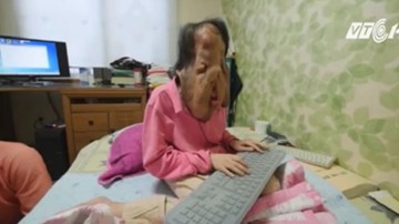 Người phụ nữ Hàn Quốc có gương mặt chảy xệ khủng khiếp vì bệnh lạ