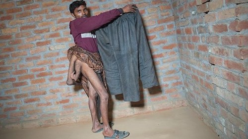 Chàng trai 'mọc' 2 chân trên lưng cầu cứu cộng đồng mạng