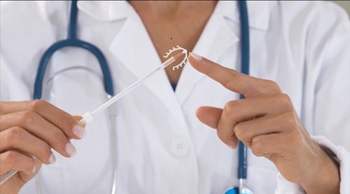 Trump thắng cử, phụ nữ Mỹ đổ xô đi đặt vòng tránh thai