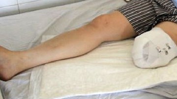 Điều tra nguyên nhân vụ nhân viên y tế tự tháo khớp chân