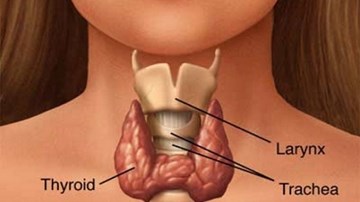 Cách chữa khỏi bướu cổ không cần mổ