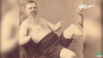 Vì sao nhiều người thích tự cắt bộ phận cơ thể?