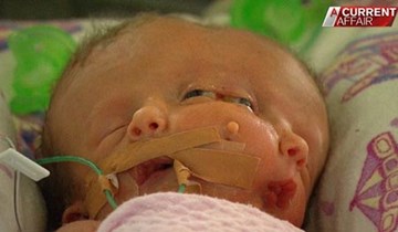 Bé gái 2 mặt chào đời ở Australia