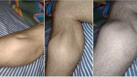 Xem hiện tượng bắp chân bị chuột rút kỳ quái