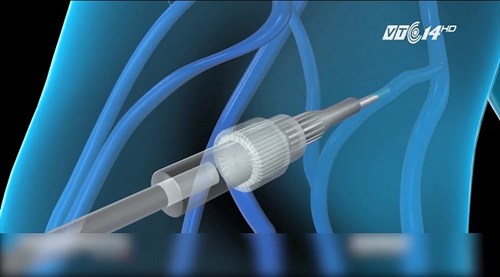 Những khả năng gây mê có thể gây chết người