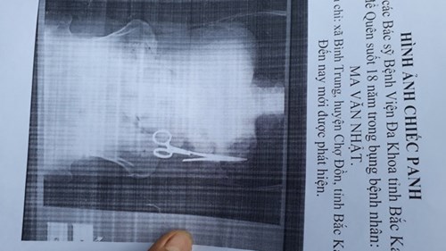 Xác minh bác sĩ quên kéo trong bụng bệnh nhân 18 năm