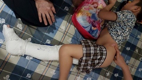 Công an vào cuộc vụ học sinh ngã gãy chân ở sân trường