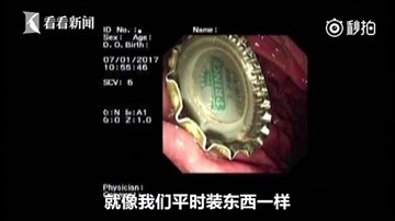 Bác sĩ dùng bao cao su lấy nắp chai bia ra khỏi dạ dày bệnh nhân