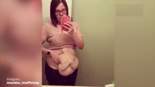 Bà mẹ bị biến dạng cơ thể sau phẫu thuật hút mỡ thừa