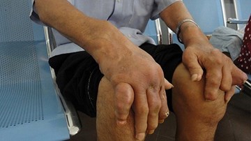 Người bị Gout nên và không nên ăn gì ngày Tết?