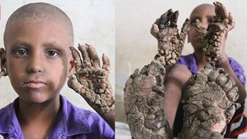 Xót xa cậu bé 8 tuổi có cơ thể đang dần hóa đá