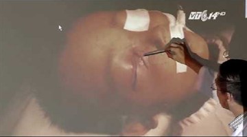 Bé trai bị đạn bi bắn xuyên mắt vì bị cậu dùng súng dọa